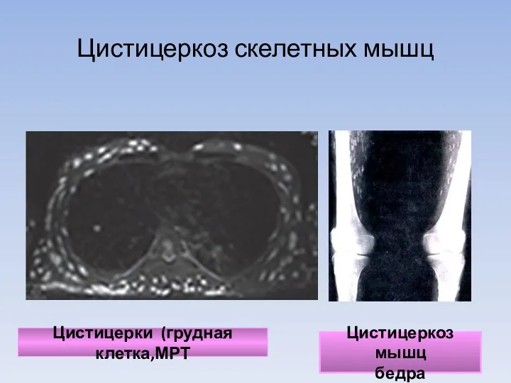 Цистицеркоз скелетных мышц Цистицеркоз мышц бедра Цистицерки (грудная клетка,МРТ