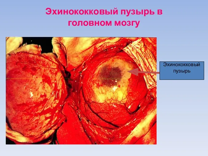 Эхинококковый пузырь в головном мозгу Эхинококковый пузырь