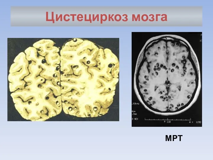 Цистециркоз мозга МРТ