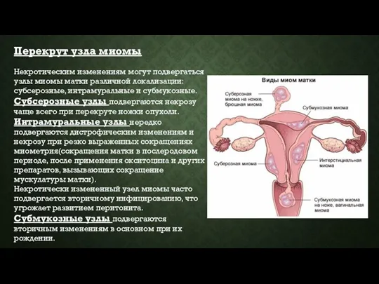 Перекрут узла миомы Некротическим изменениям могут подвергаться узлы миомы матки