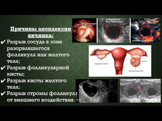 Причины апоплексии яичника: Разрыв сосуда в зоне разорвавшегося фолликула или