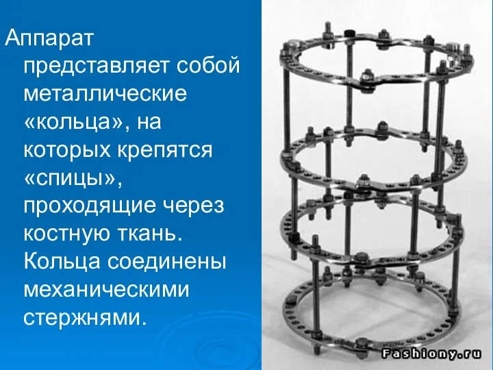 Аппарат представляет собой металлические «кольца», на которых крепятся «спицы», проходящие