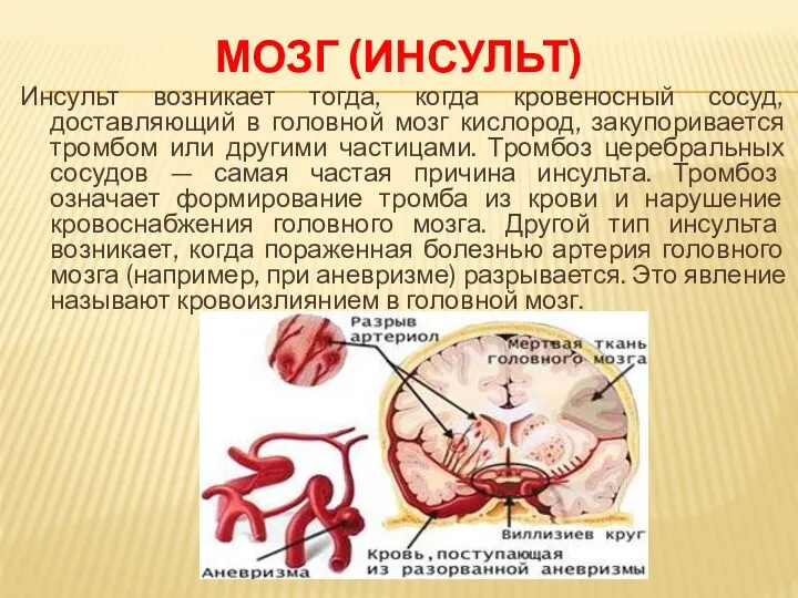 МОЗГ (ИНСУЛЬТ) Инсульт возникает тогда, когда кровеносный сосуд, доставляющий в