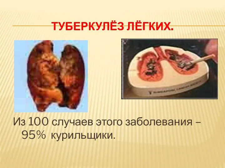 ТУБЕРКУЛЁЗ ЛЁГКИХ. Из 100 случаев этого заболевания – 95% курильщики.