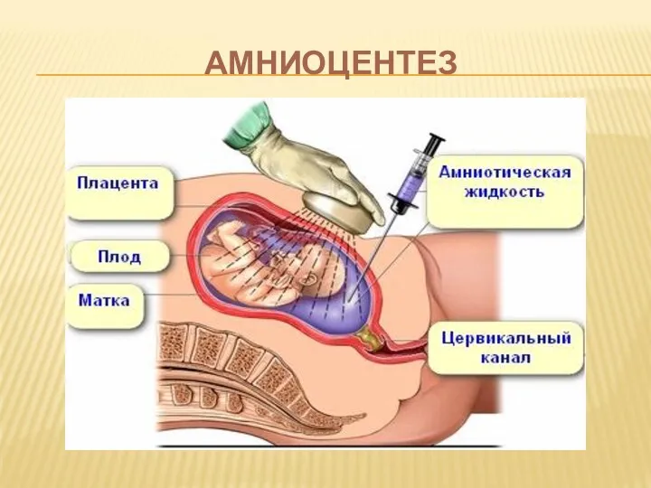 АМНИОЦЕНТЕЗ