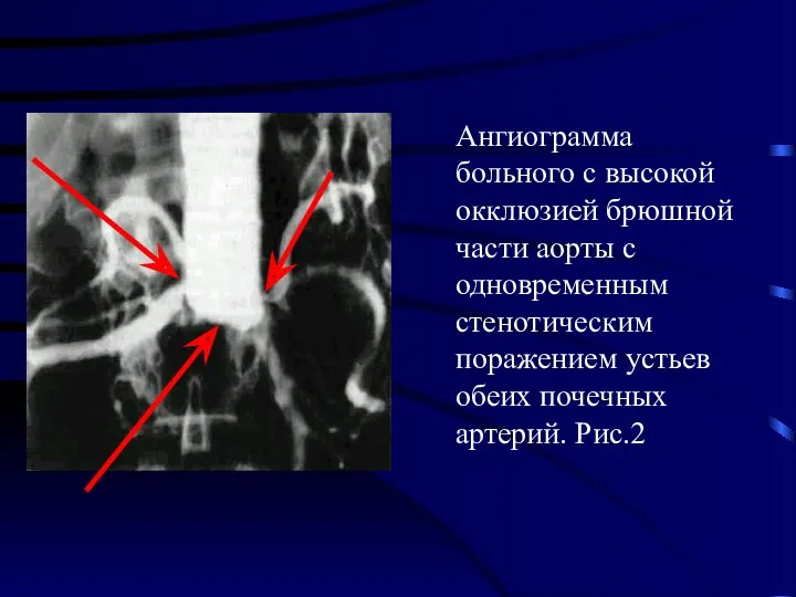 Ангиограмма больного с высокой окклюзией брюшной части аорты с одновременным