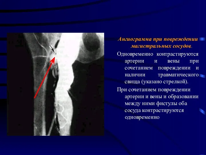 Ангиограмма при повреждении магистральных сосудов. Одновременно контрастируются артерии и вены