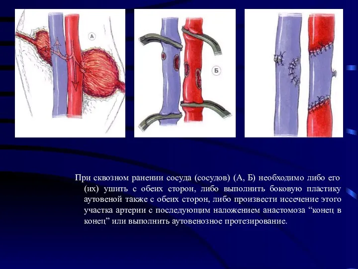 При сквозном ранении сосуда (сосудов) (А, Б) необходимо либо его