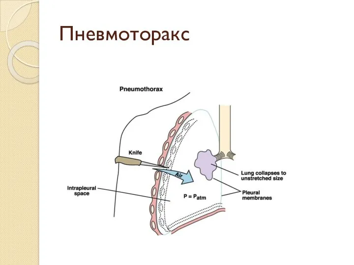 Пневмоторакс