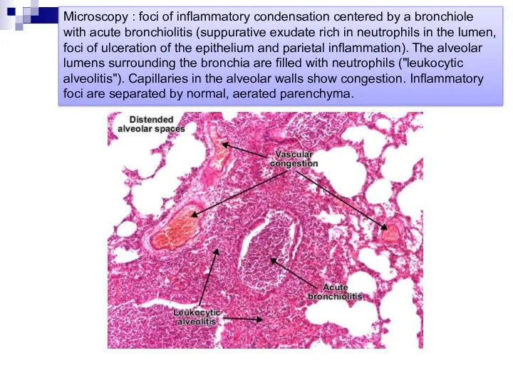 Microscopy : foci of inflammatory condensation centered by a bronchiole