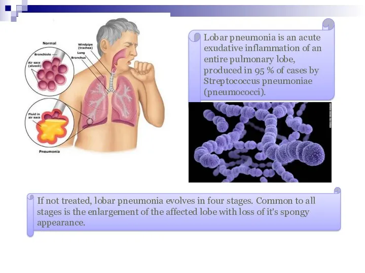 Lobar pneumonia is an acute exudative inflammation of an entire