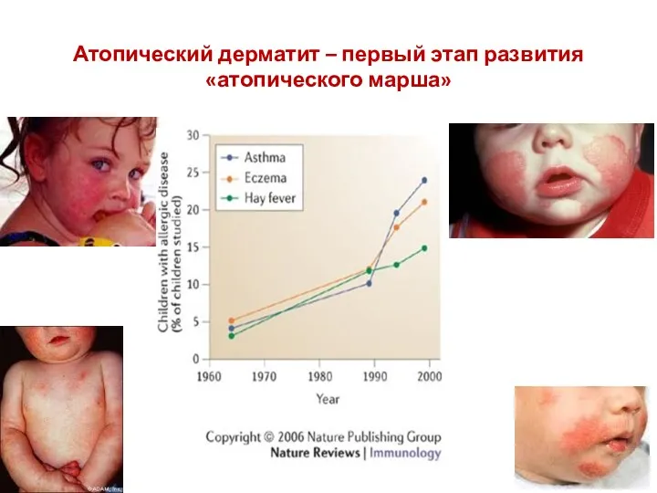 Атопический дерматит – первый этап развития «атопического марша»