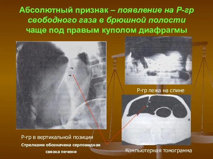 Абсолютный признак – появление на Р-гр свободного газа в брюшной полости чаще под