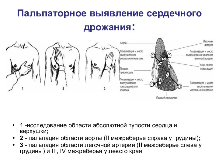 Пальпаторное выявление сердечного дрожания: 1.-исследование области абсолютной тупости сердца и