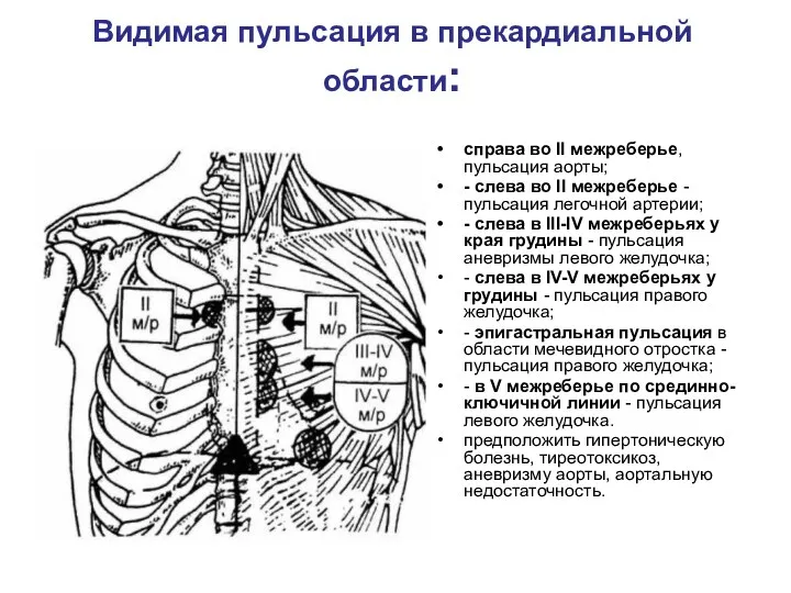 Видимая пульсация в прекардиальной области: справа во II межреберье, пульсация