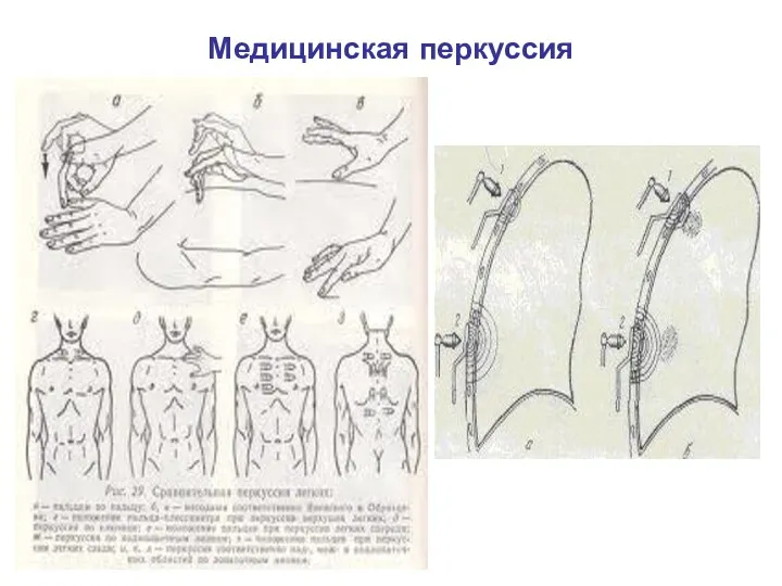 Медицинская перкуссия