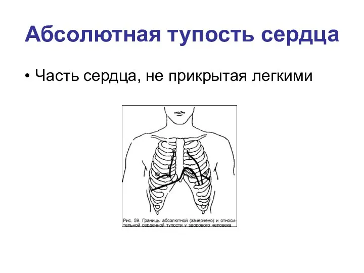 Абсолютная тупость сердца Часть сердца, не прикрытая легкими