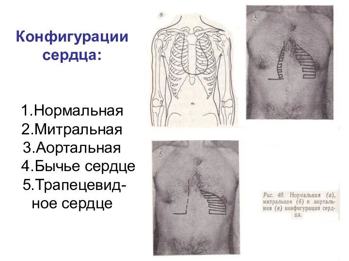 Конфигурации сердца: 1.Нормальная 2.Митральная 3.Аортальная 4.Бычье сердце 5.Трапецевид- ное сердце