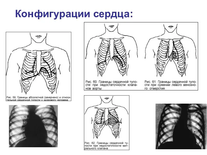 Конфигурации сердца: