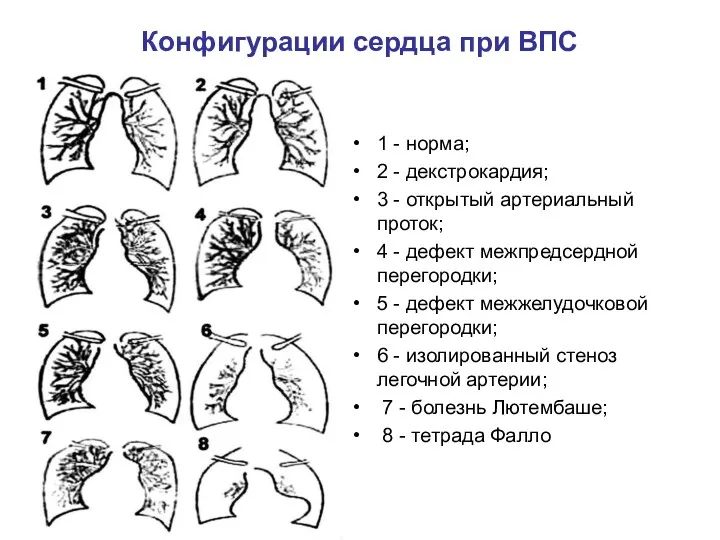 Конфигурации сердца при ВПС 1 - норма; 2 - декстрокардия;