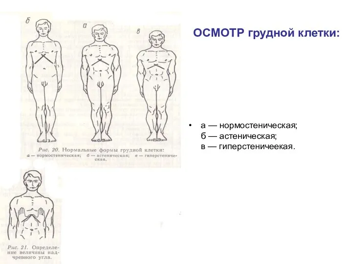 ОСМОТР грудной клетки: а — нормостеническая; б — астеническая; в — гиперстеничеекая.