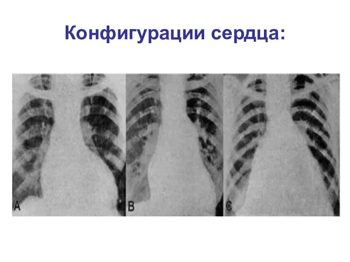 Конфигурации сердца: