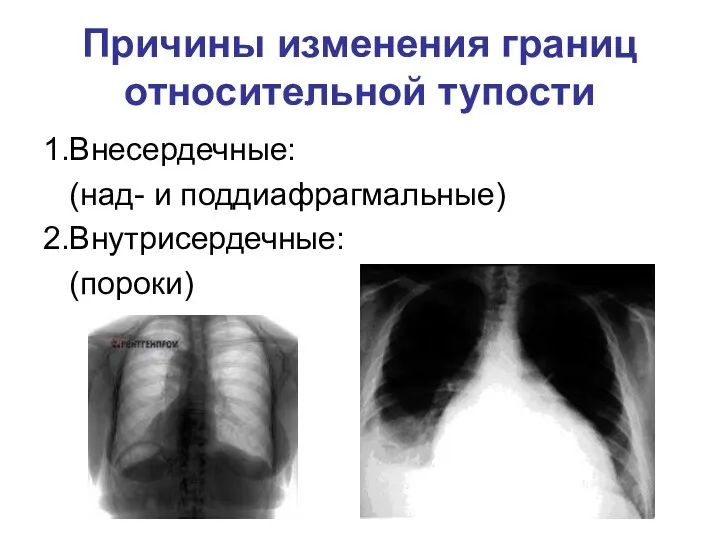 Причины изменения границ относительной тупости 1.Внесердечные: (над- и поддиафрагмальные) 2.Внутрисердечные: (пороки)