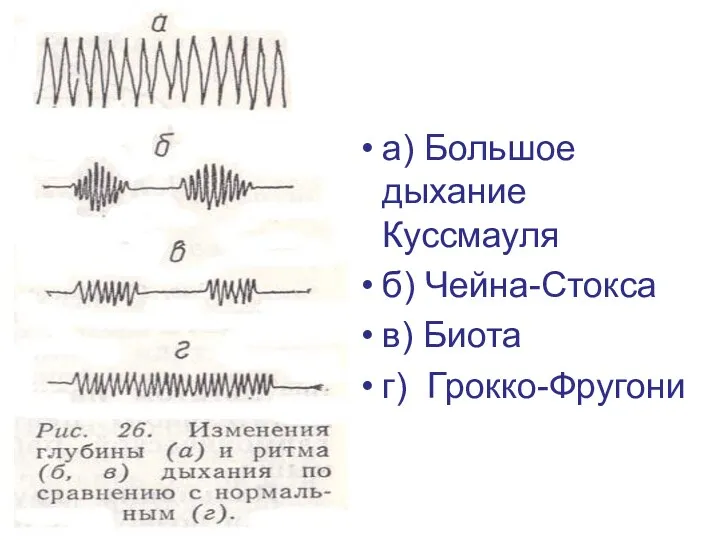 а) Большое дыхание Куссмауля б) Чейна-Стокса в) Биота г) Грокко-Фругони