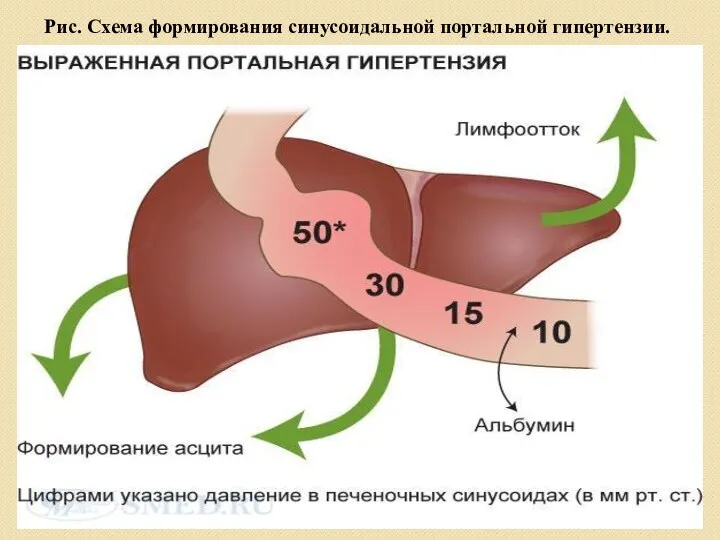 Рис. Схема формирования синусоидальной портальной гипертензии.