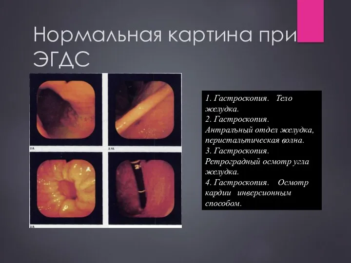 Нормальная картина при ЭГДС 1. Гастроскопия. Тело желудка. 2. Гастроскопия. Антралъный отдел желудка,