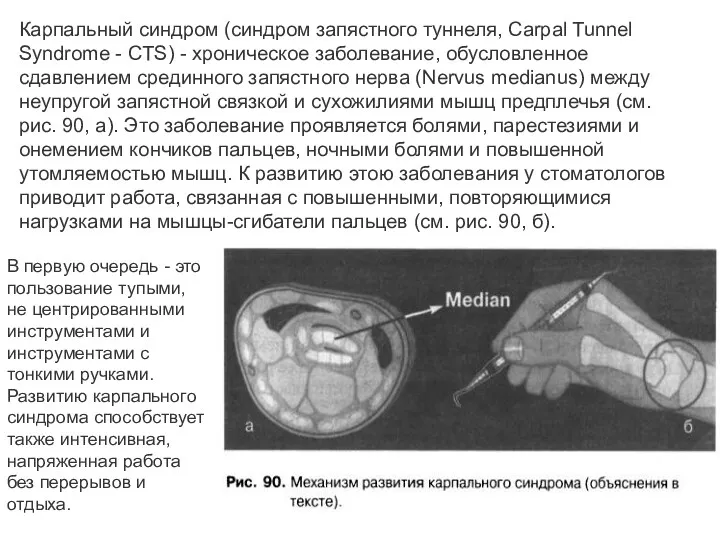 Карпальный синдром (синдром запястного туннеля, Carpal Tunnel Syndrome - CTS)