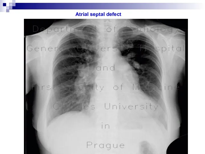 Atrial septal defect