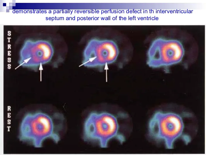 demonstrates a partially reversible perfusion defect in th interventricular septum