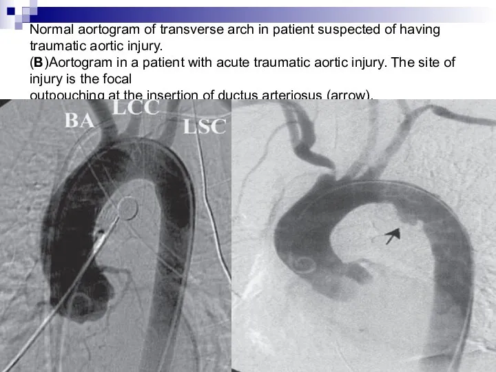 Normal aortogram of transverse arch in patient suspected of having
