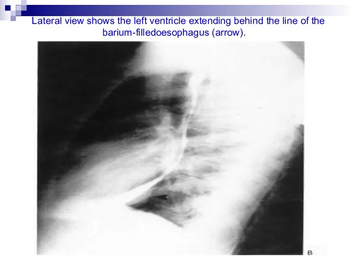 Lateral view shows the left ventricle extending behind the line of the barium-filledoesophagus (arrow).