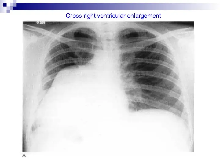 Gross right ventricular enlargement
