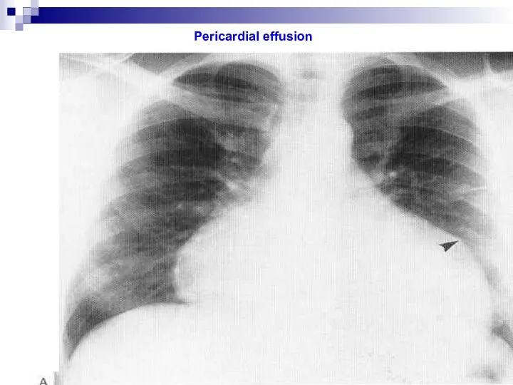 Pericardial effusion