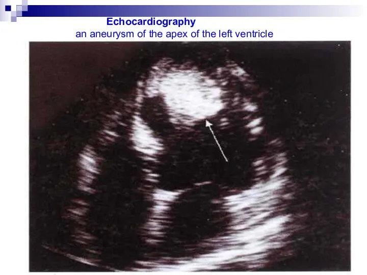 Echocardiography an aneurysm of the apex of the left ventricle