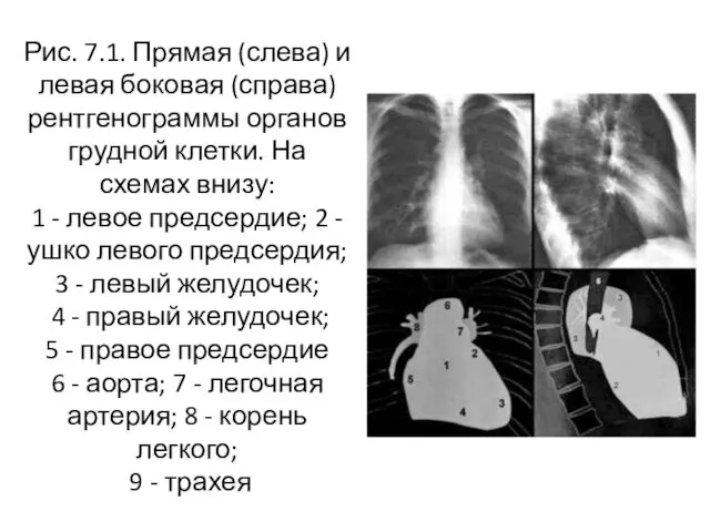 Рис. 7.1. Прямая (слева) и левая боковая (справа) рентгенограммы органов грудной клетки. На