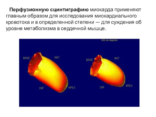 Перфузионную сцинтиграфию миокарда применяют главным образом для исследования миокардиального кровотока