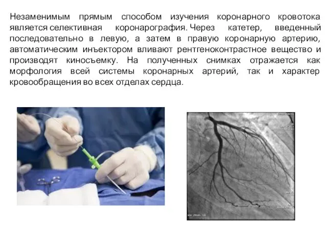 Незаменимым прямым способом изучения коронарного кровотока является селективная коронарография. Через катетер, введенный последовательно