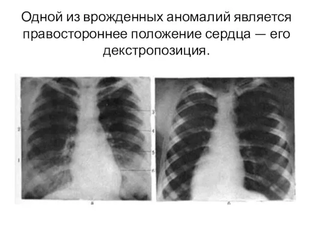 Одной из врожденных аномалий является правостороннее положение сердца — его декстропозиция.