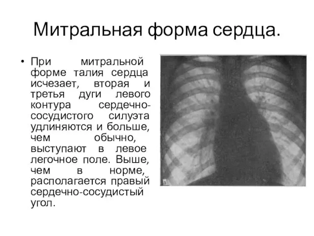 Митральная форма сердца. При митральной форме талия сердца исчезает, вторая