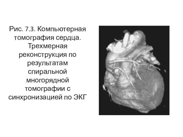 Рис. 7.3. Компьютерная томография сердца. Трехмерная реконструкция по результатам спиральной многорядной томографии с синхронизацией по ЭКГ