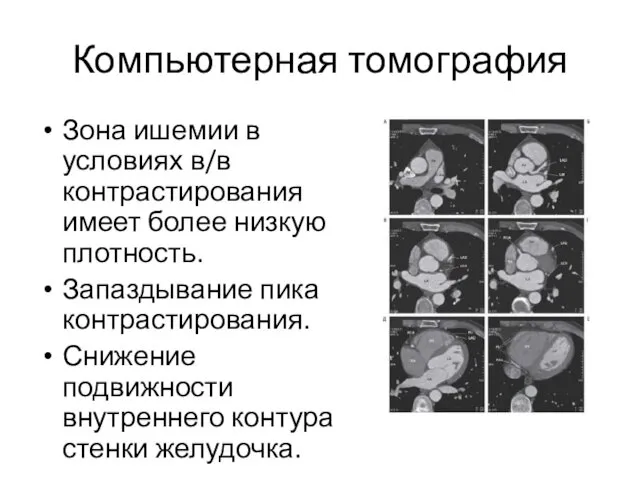 Компьютерная томография Зона ишемии в условиях в/в контрастирования имеет более низкую плотность. Запаздывание