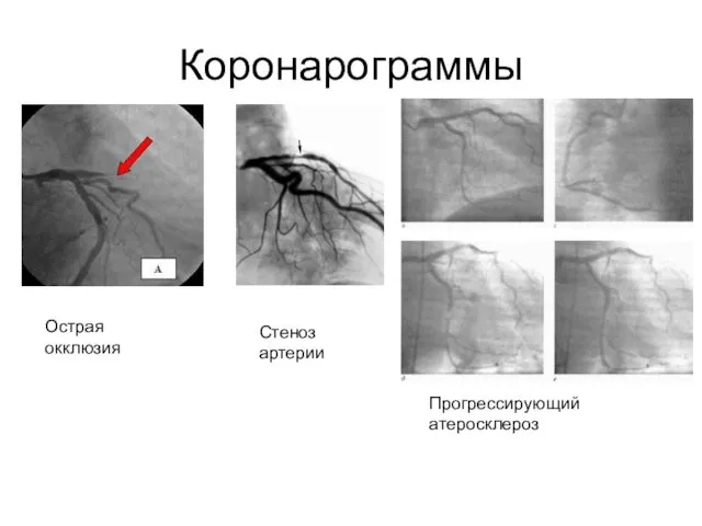 Коронарограммы Острая окклюзия Стеноз артерии Прогрессирующий атеросклероз