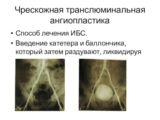 Чрескожная транслюминальная ангиопластика Способ лечения ИБС. Введение катетера и баллончика, который затем раздувают, ликвидируя стеноз.