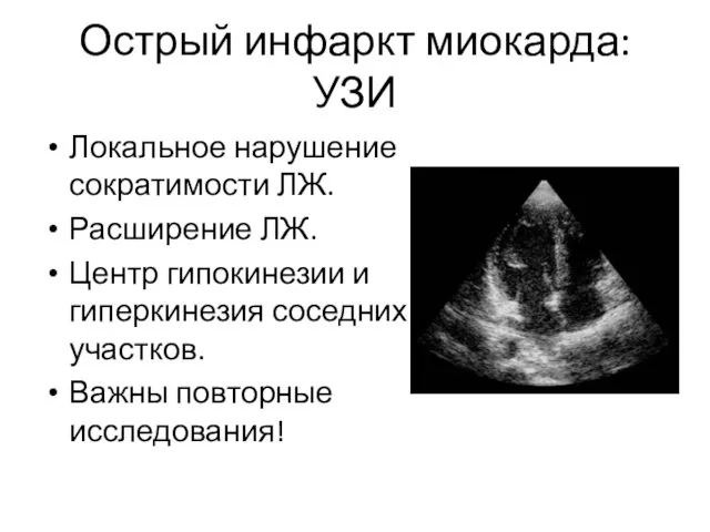 Острый инфаркт миокарда: УЗИ Локальное нарушение сократимости ЛЖ. Расширение ЛЖ.