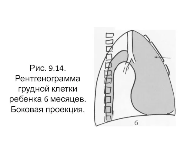 Рис. 9.14. Рентгенограмма грудной клетки ребенка 6 месяцев. Боковая проекция.