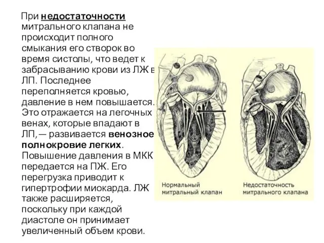 При недостаточности митрального клапана не происходит полного смыкания его створок во время систолы,